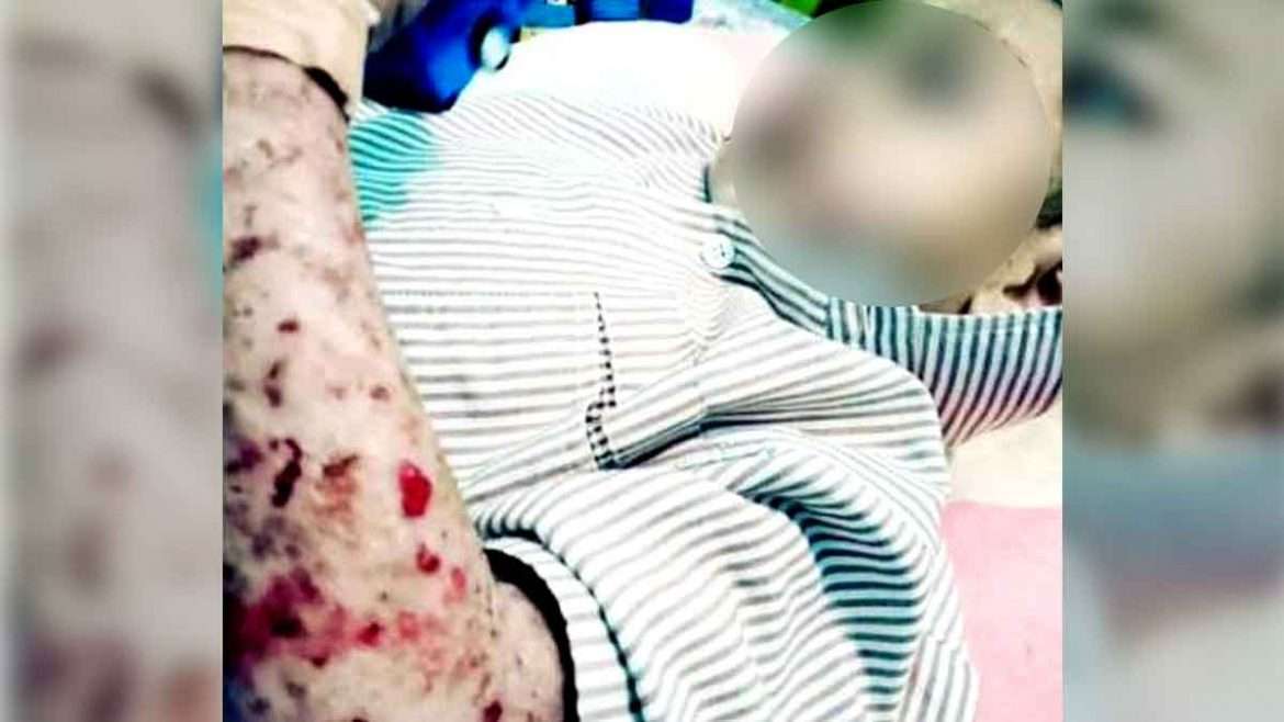 Bocah Asal Desa Neglasari Penderita Penyakit kulit Misterius Butuhkan Uluran Tangan