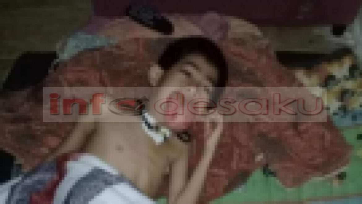 Anak Usia 8 Tahun di Sukabumi Penderita Tumor Lidah Butuhkan Perhatian Khusus Pemerintah